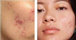 cham-soc-da-sau-khi-lay-nhan-mun