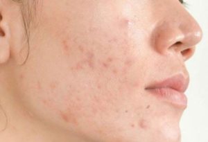 cham-soc-da-sau-khi-lay-nhan-mun