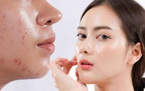 cham-soc-da-dau-mun-lo-chan-long-to-ayana