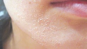 cham-soc-da-bi-di-ung-my-pham