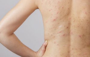 cham-soc-da-bi-viem-nang-long