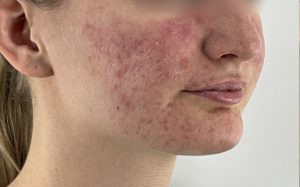 cham-soc-da-khi-uong-isotretinoin