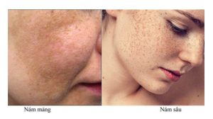 da-mong-yeu-co-nen-dung-kem-tri-nam-khong