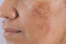 vi-sao-tri-nam-lau-nam-rat-de-tai-phat