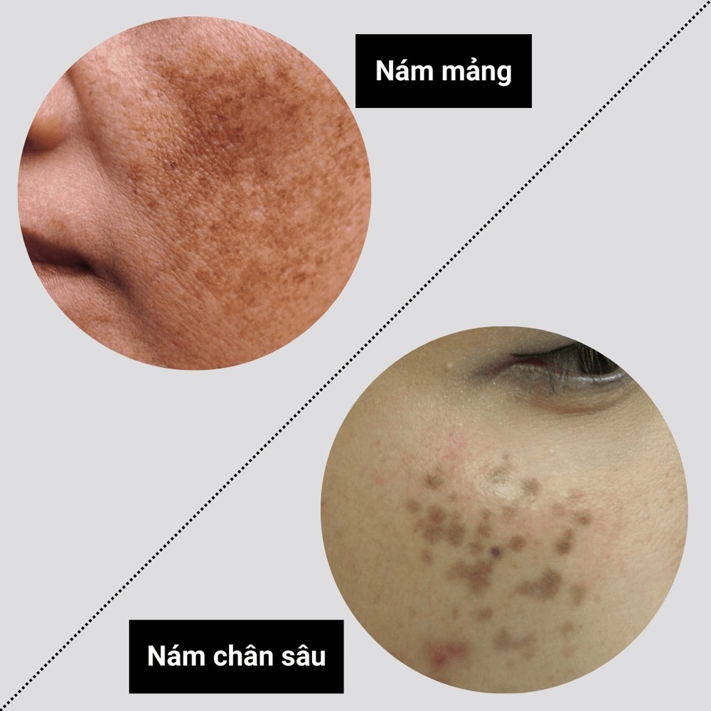 Nám Chân Sâu Và Nám Mảng Khác Nhau Như Thế Nào