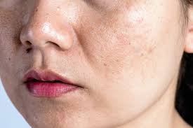 Nám Da Có Tự Hết Không