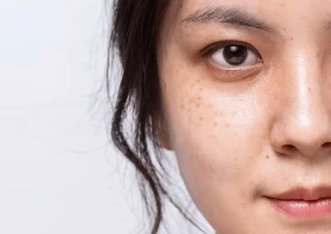 Nám Da Có Tự Hết Không