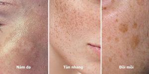 Phân Biệt Nám Da, Tàn Nhang Và Đồi Mồi