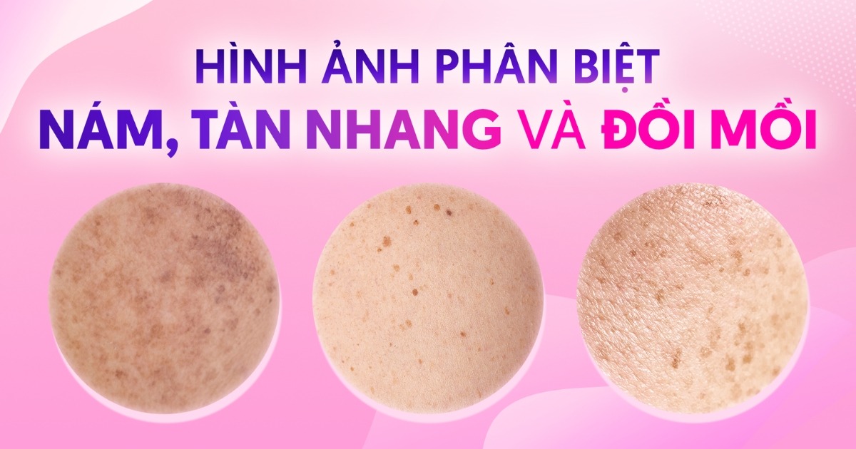 Phân Biệt Nám Da, Tàn Nhang Và Đồi Mồi