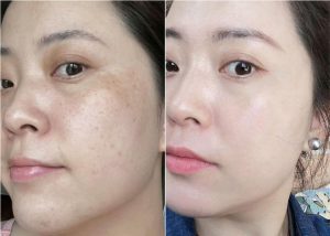 Vì Sao Nám Da Càng Điều Trị Càng Đậm Màu
