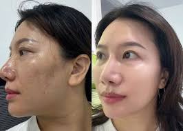 Vì Sao Nám Da Càng Điều Trị Càng Đậm Màu