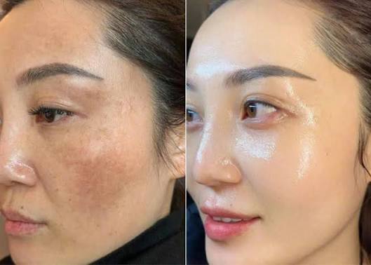 15 Sai Lầm Khi Chăm Sóc Da Nám
