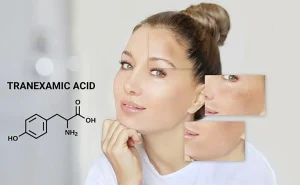 Da Nám Có Nên Dùng Tranexamic Acid Không