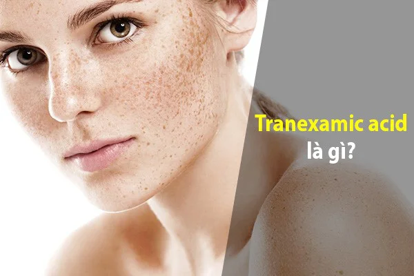 Da Nám Có Nên Dùng Tranexamic Acid Không